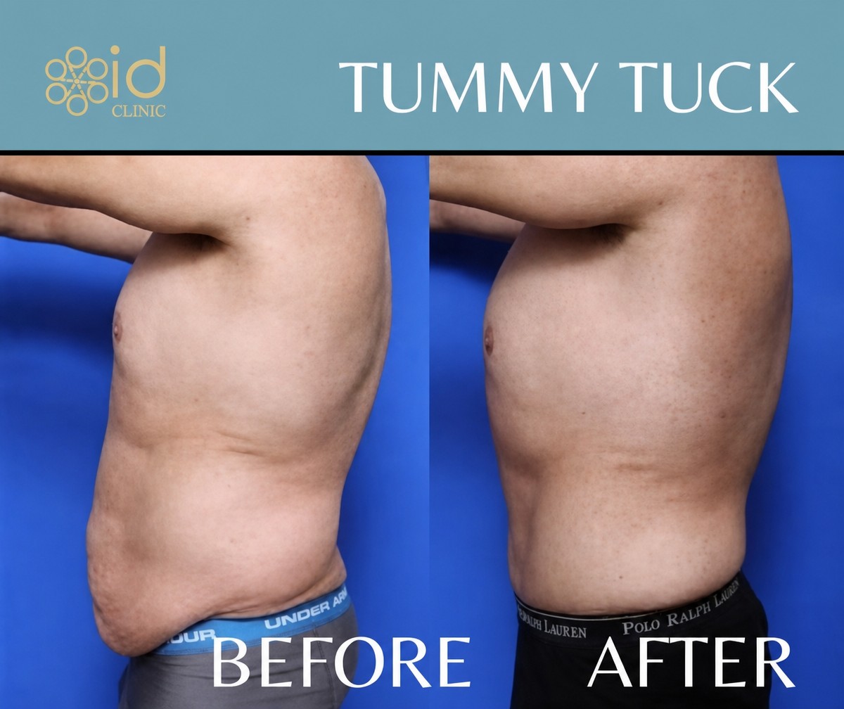 Male tummy tuck before and after results at ID Clinic Bangkok, improved abdominal contour