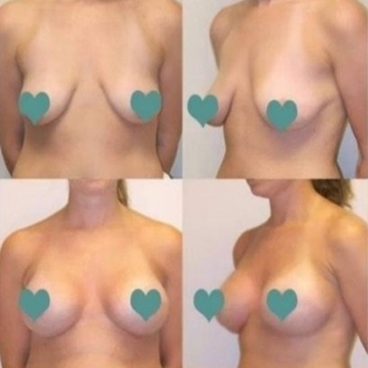 Before and after breast augmentation with silicone implants at ID Clinic Bangkok, visible results
