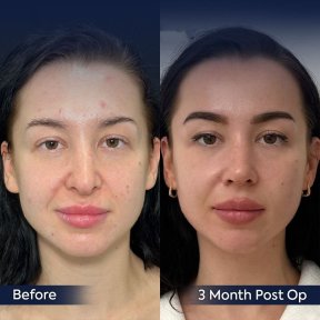 Premium Rhinoplasty (nose job) All Included - photo 6