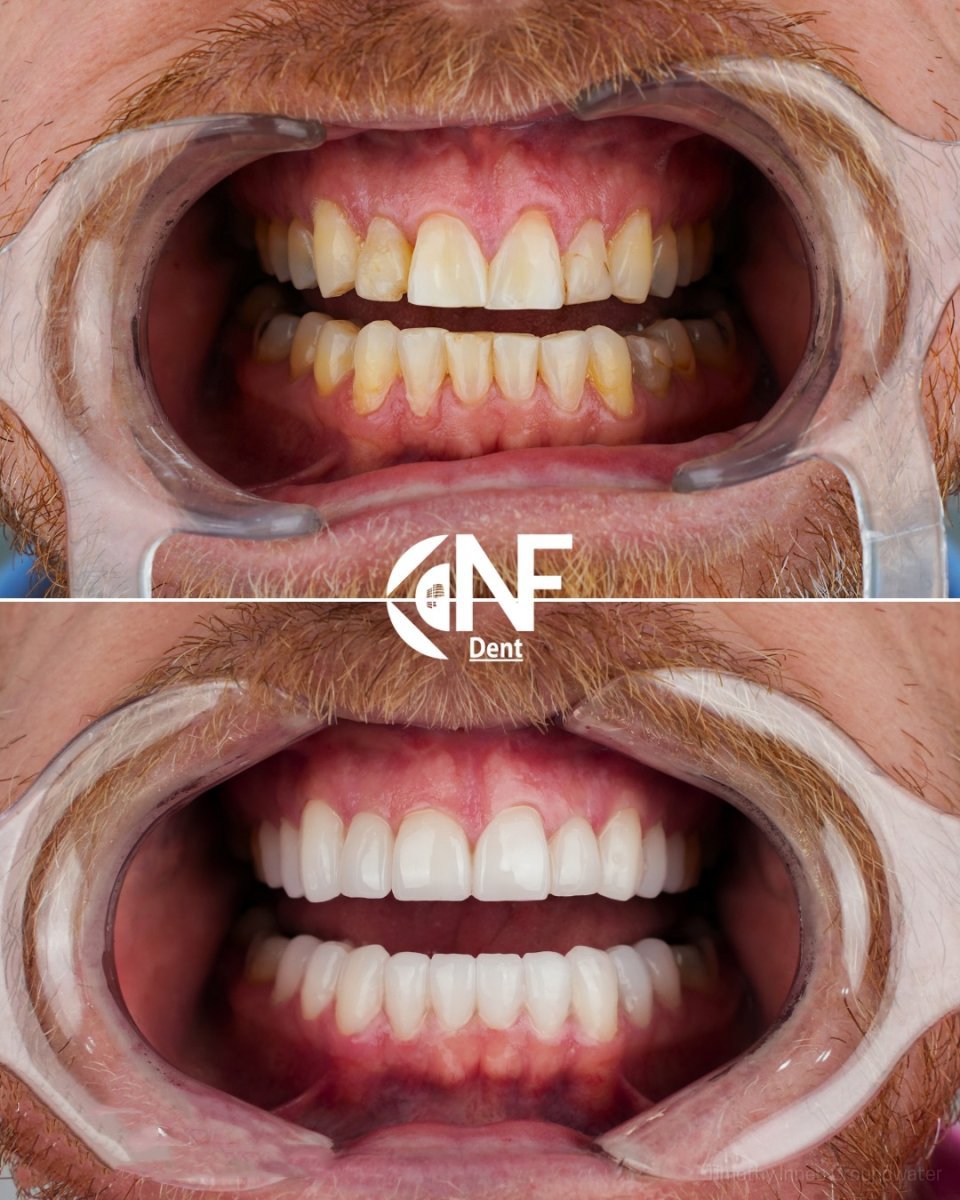Before and after smile makeover at Nifa Dent International, dental veneers result for men