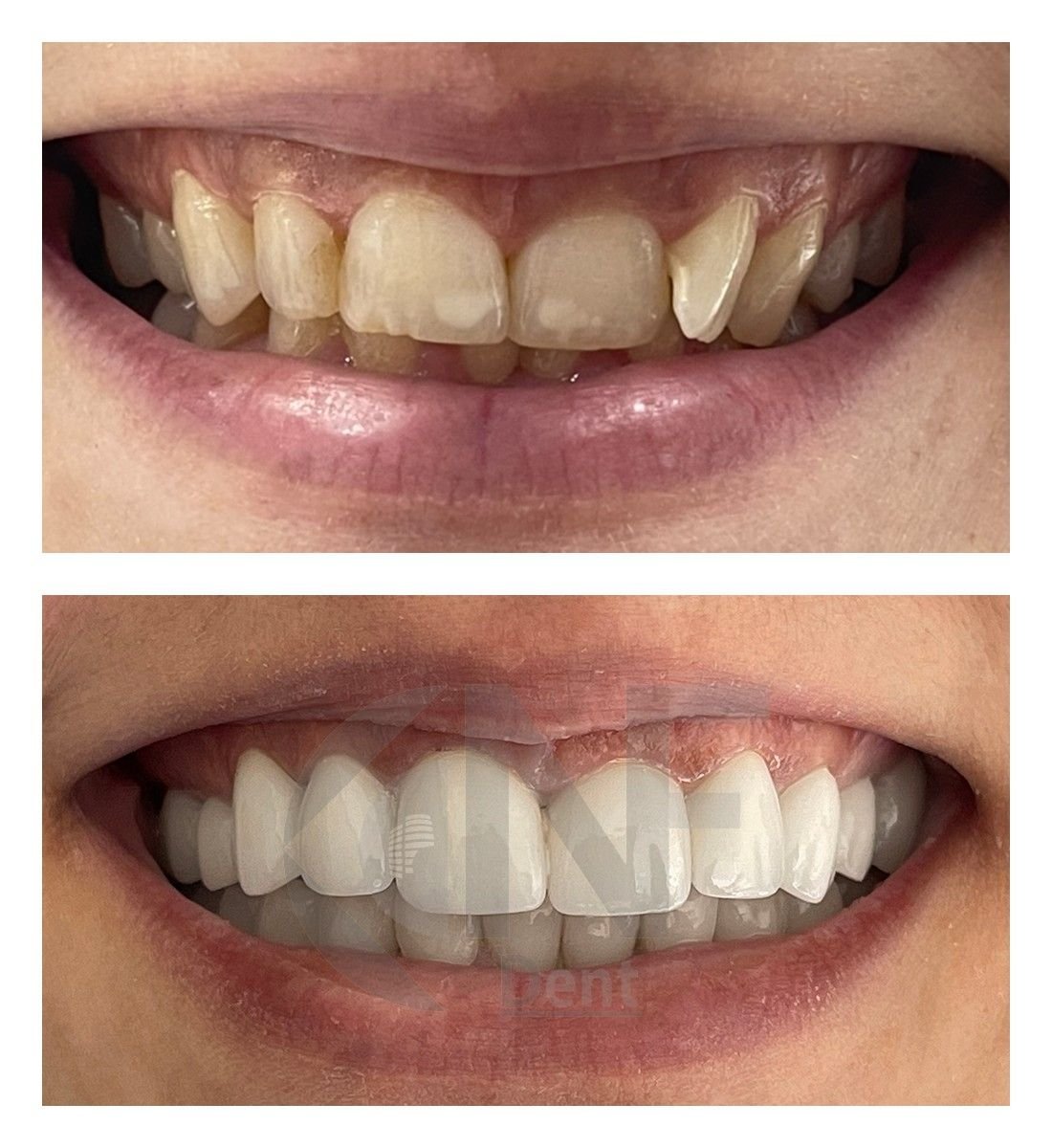 نتائج قبل وبعد تجميل الابتسامة بالفينير في عيادة Nifa Dent International