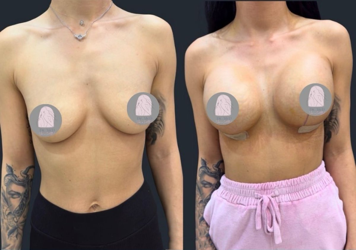 نتائج تكبير الثدي قبل وبعد في Dr. MED – تحسين شكل وحجم الثدي