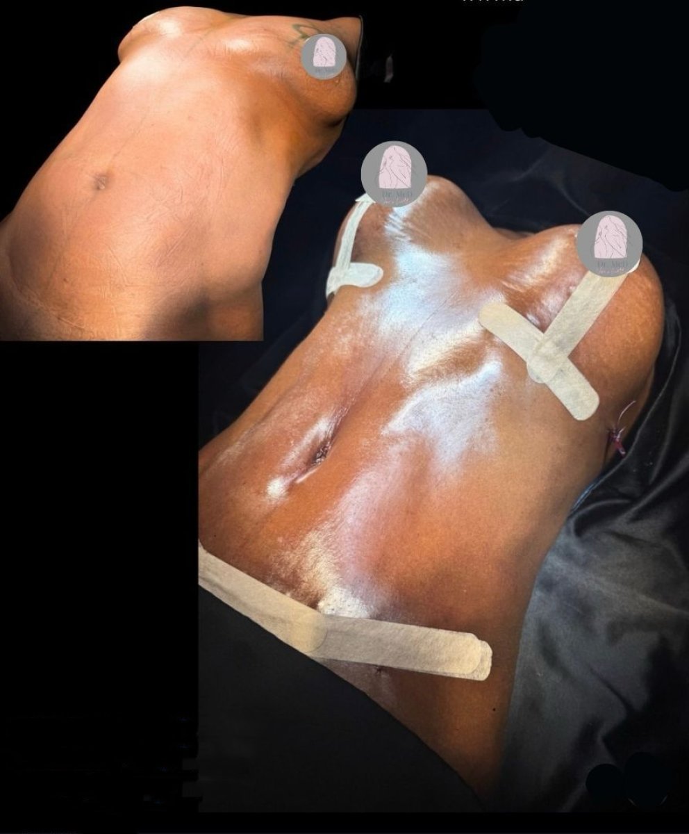 نتائج قبل وبعد لمامي ميك أوفر في Dr. MED – تحسين شكل الجسم والبطن