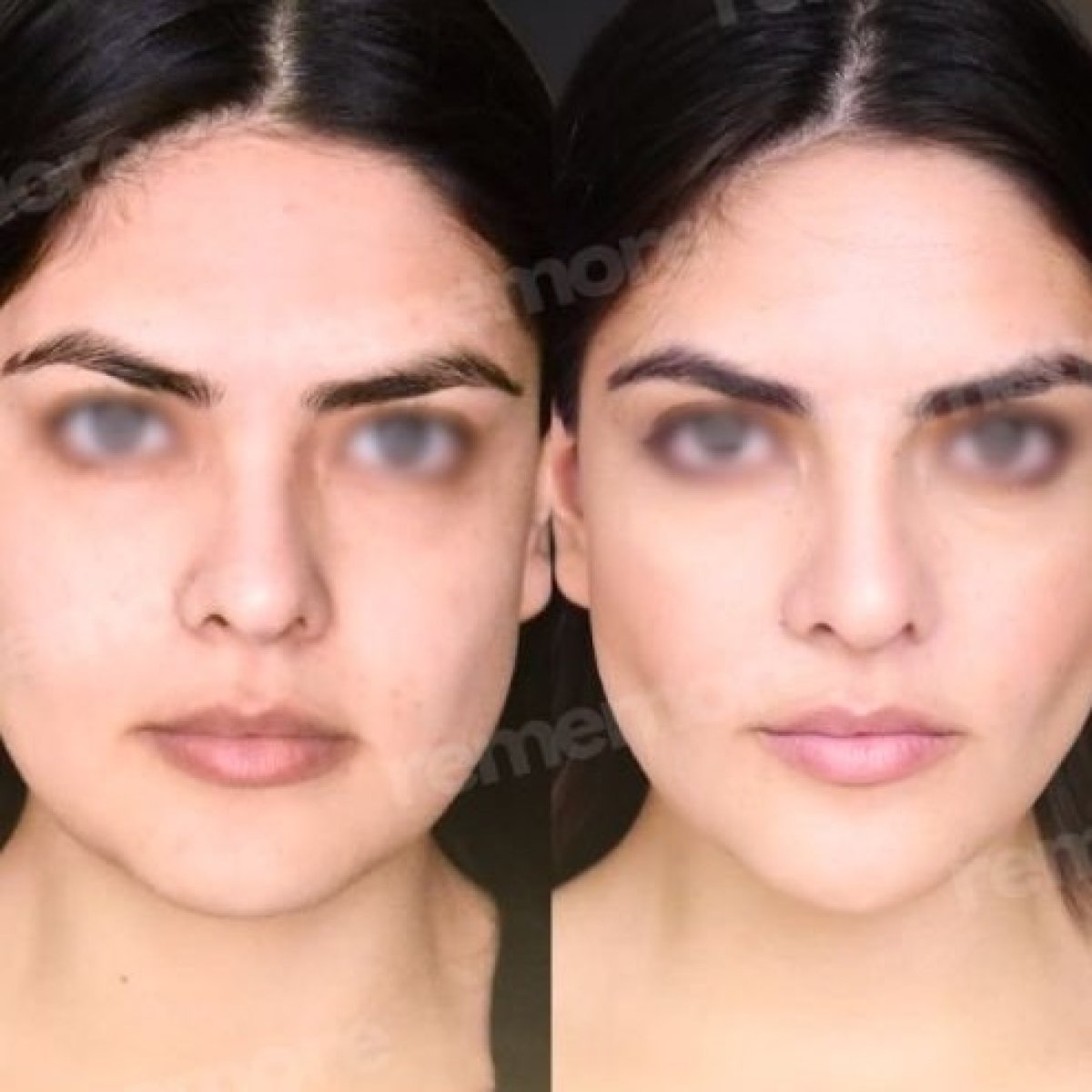 Resultados antes y después de rinoplastia de punta en Memorial Bahçelievler Hospital, nariz refinada