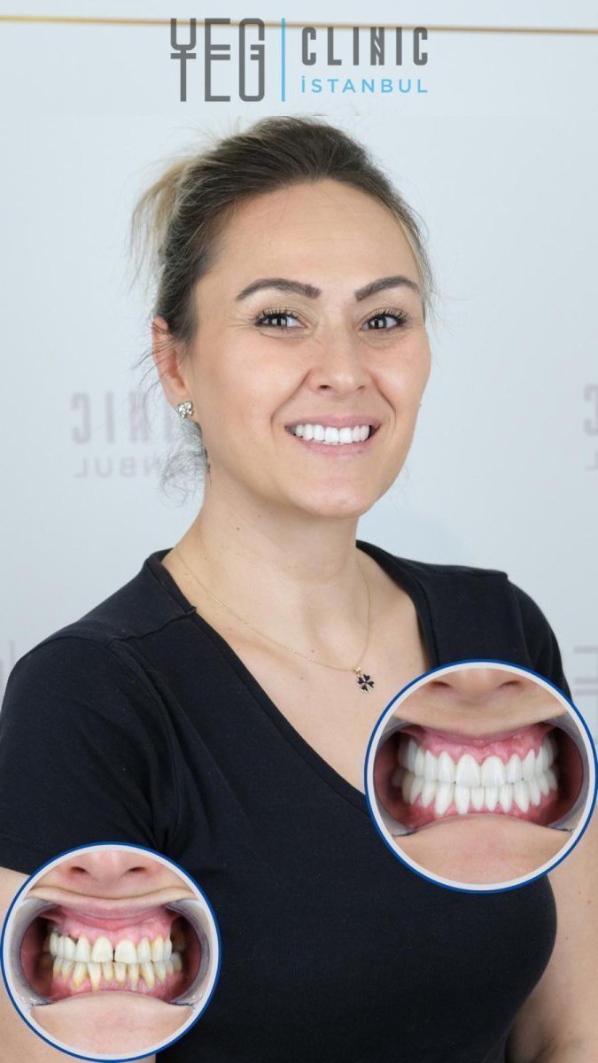 Resultados antes y después de implante dental con pilar en YEG Clinic, sonrisa mejorada