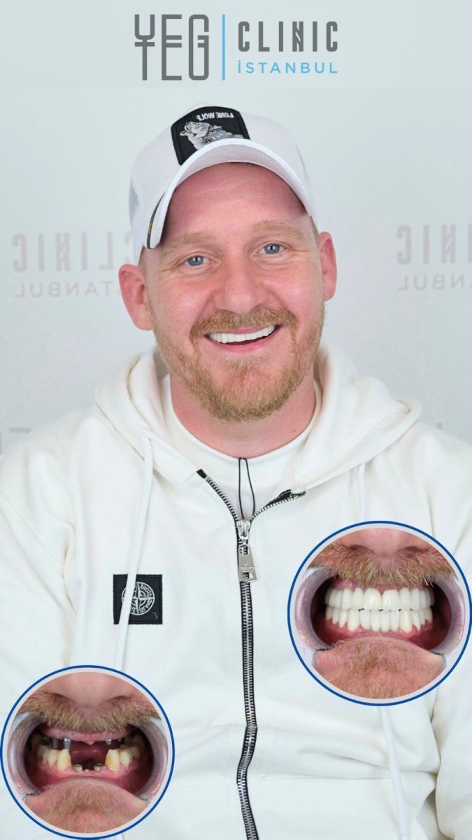 Resultados antes y después de implante dental con pilar en YEG Clinic, sonrisa mejorada