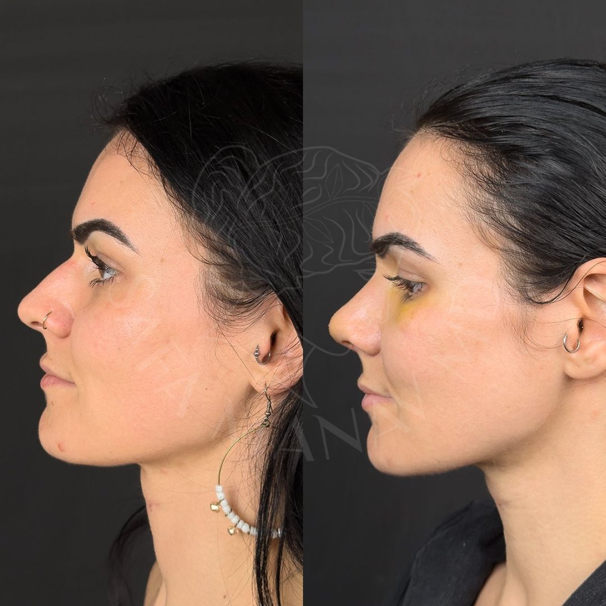 نتائج عملية تجميل الأنف قبل وبعد في عيادة Dr. Safa Manav، إعادة تشكيل الأنف للنساء
