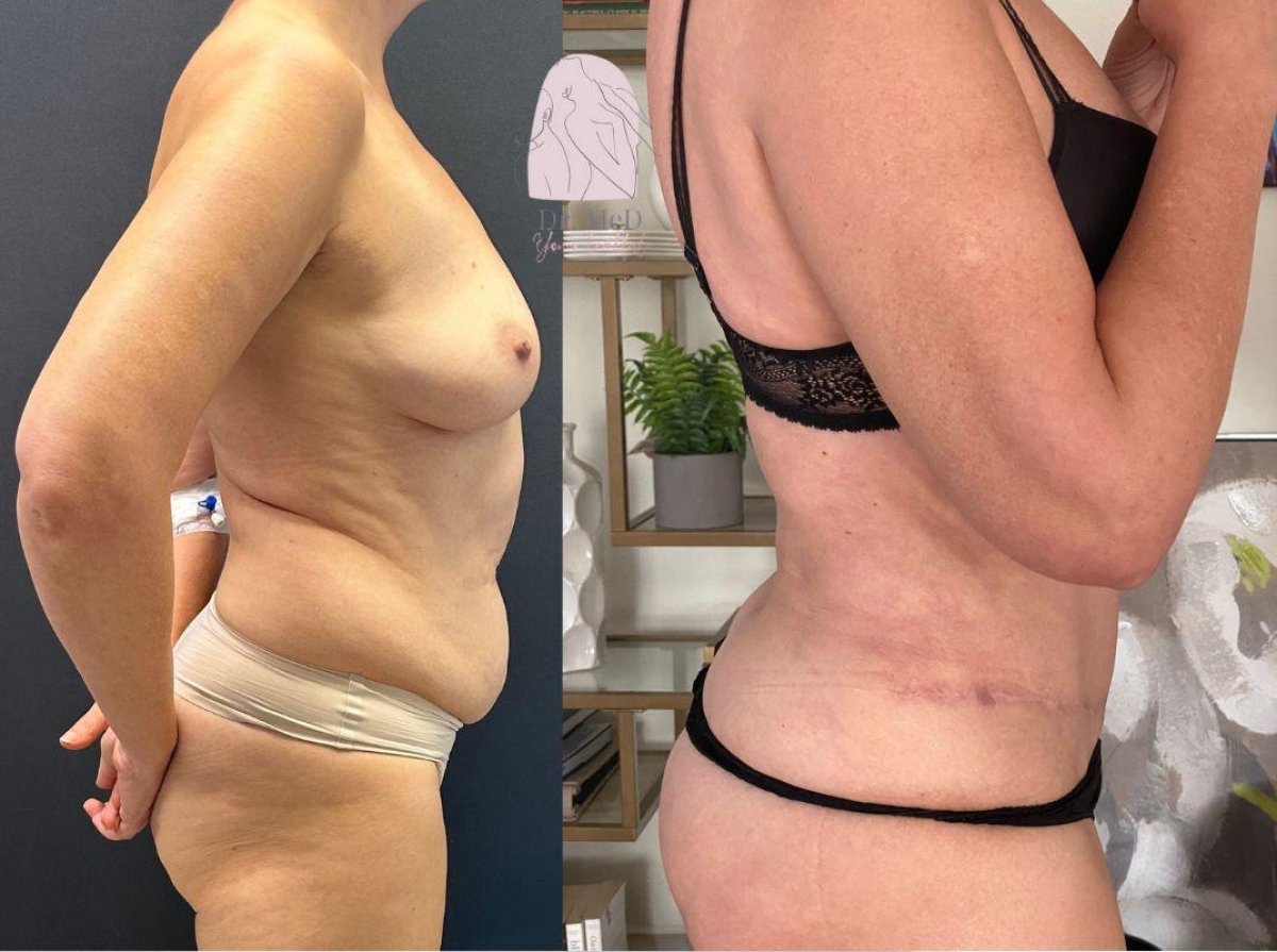 نتائج شفط الدهون قبل وبعد في Dr. MED – تحسين شكل الجسم وتقليل الدهون بوضوح