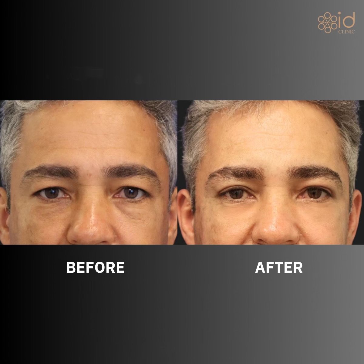 Resultados de blefaroplastia superior antes y después en ID Clinic Bangkok, ojos rejuvenecidos