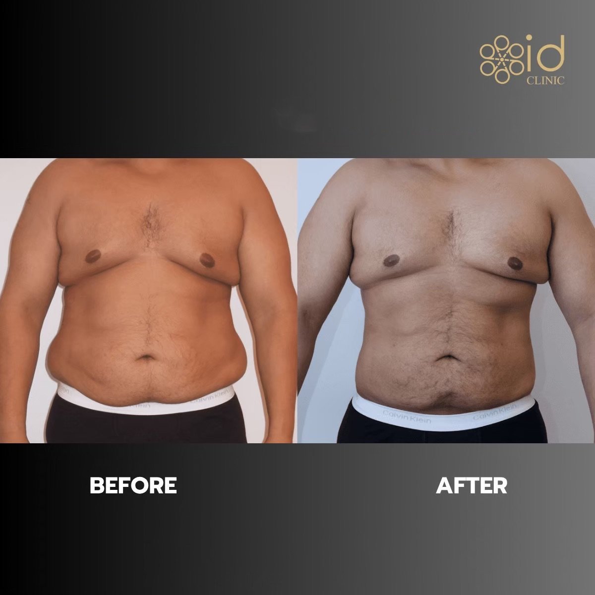 Before and after liposuction results at ID Clinic Bangkok, visible abdominal contour improvement