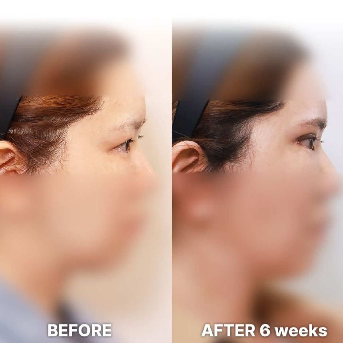 Before and after Fox Eye Lift results at Returning Plastic Surgery, lifted eye contour visible