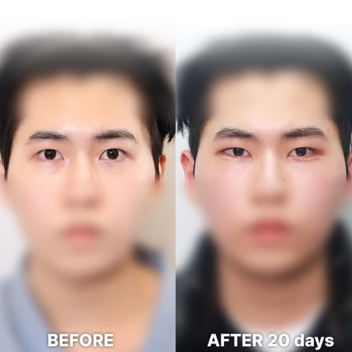 Fox Eye Lift before and after 20 days result at Returning Plastic Surgery, lifted eye contour