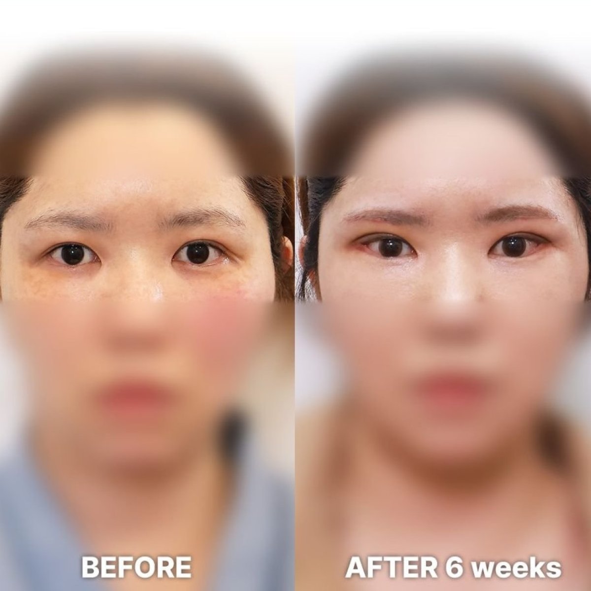 Fox Eye Lift before and after results at Returning Plastic Surgery, visible eye shape enhancement