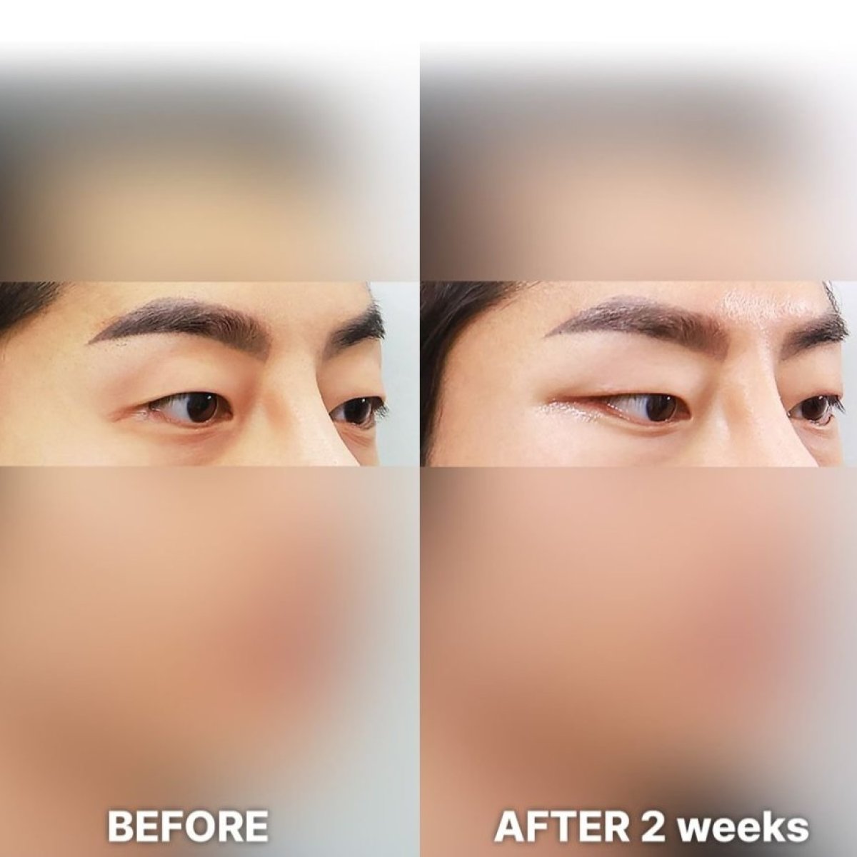 Fox Eye Lift before and after results at Returning Plastic Surgery, lifted eye contour visible