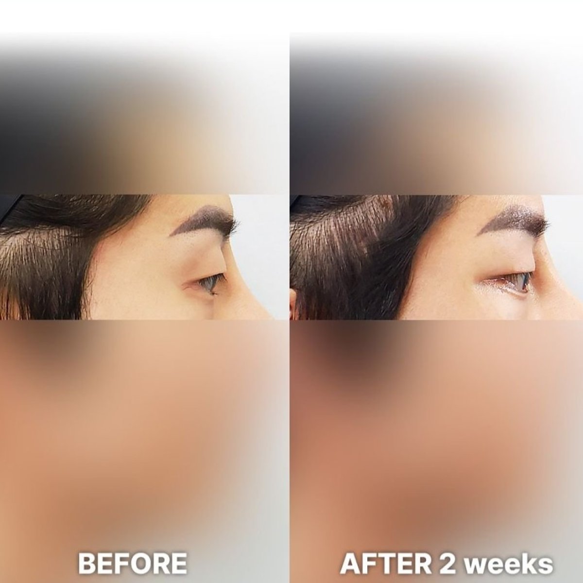 Fox Eye Lift before and after results at Returning Plastic Surgery, visible brow lift effect