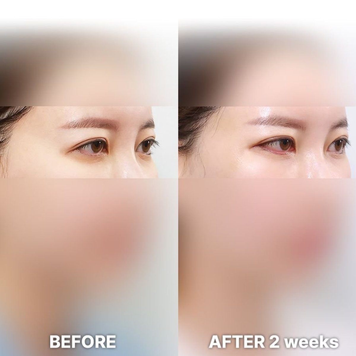 Fox Eye Lift before and after results at Returning Plastic Surgery, visible eye lift after 2 weeks