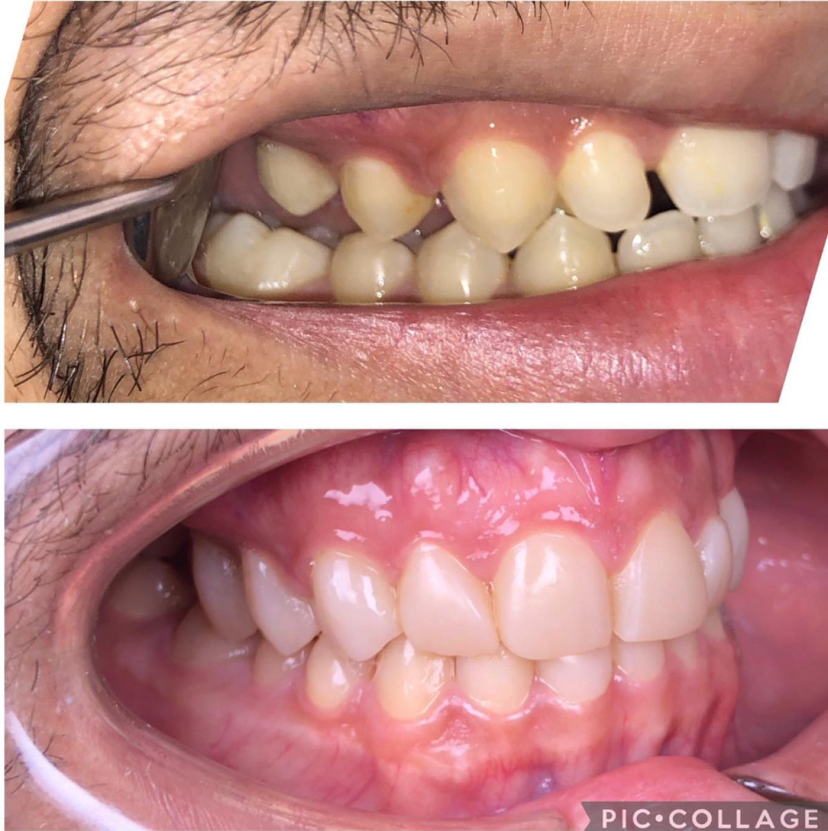 Результаты до и после композитных виниров в Professional Dental Care Clinic, улучшенная улыбка