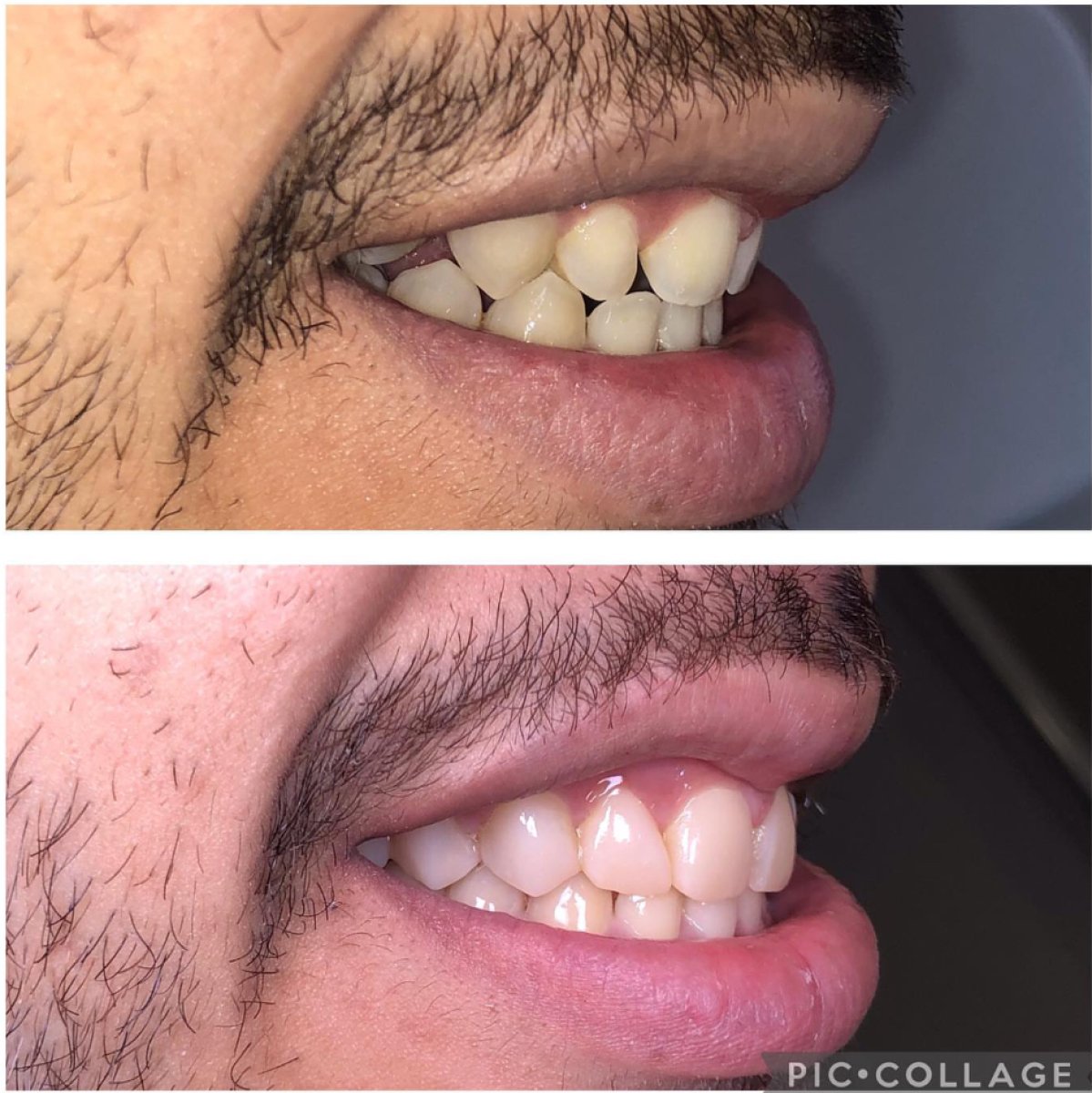 Before and after composite veneer results at Professional Dental Care Clinic, improved smile