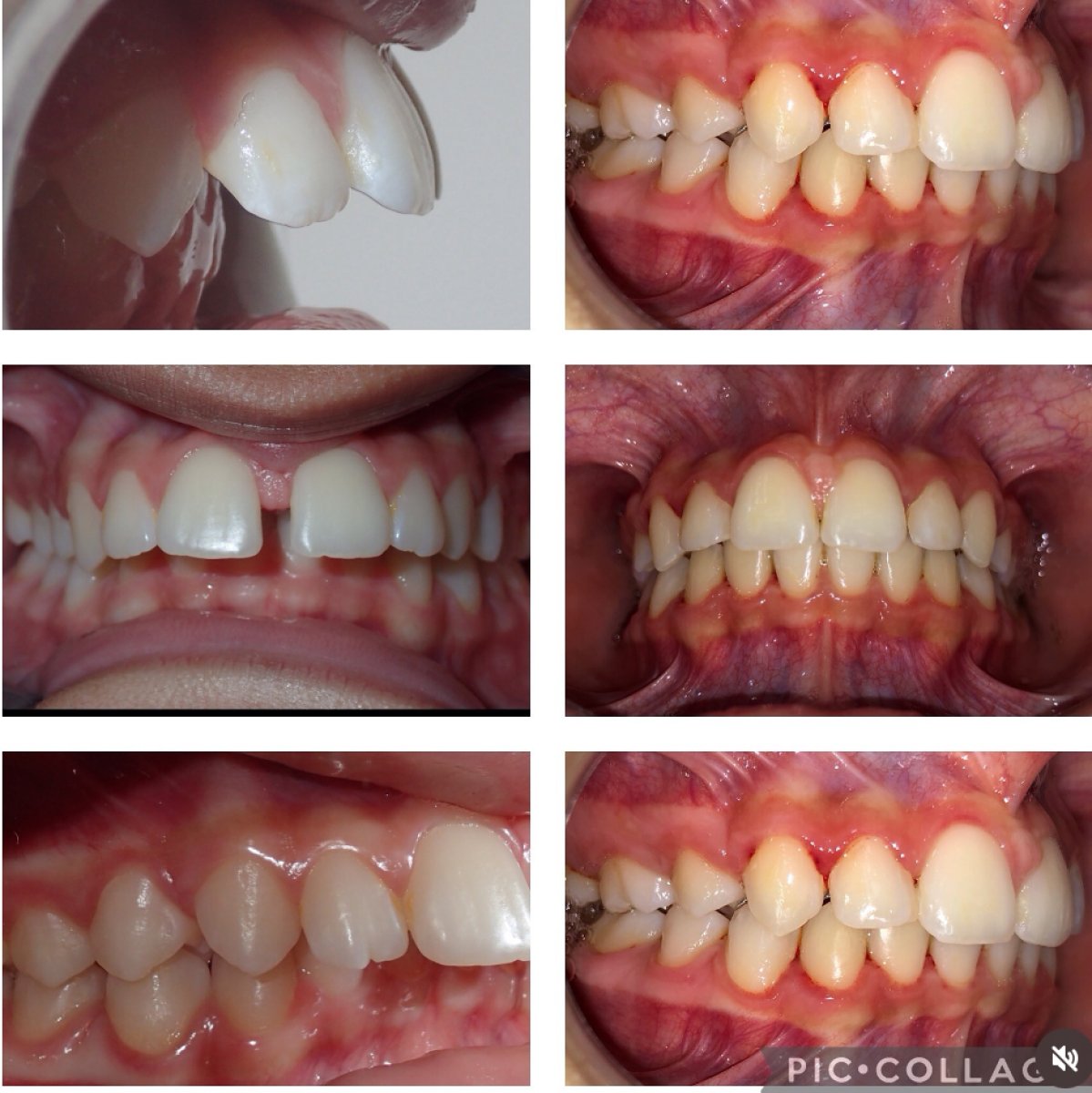 Resultados antes y después de brackets en Professional Dental Care Clinic – alineación dental mejorada