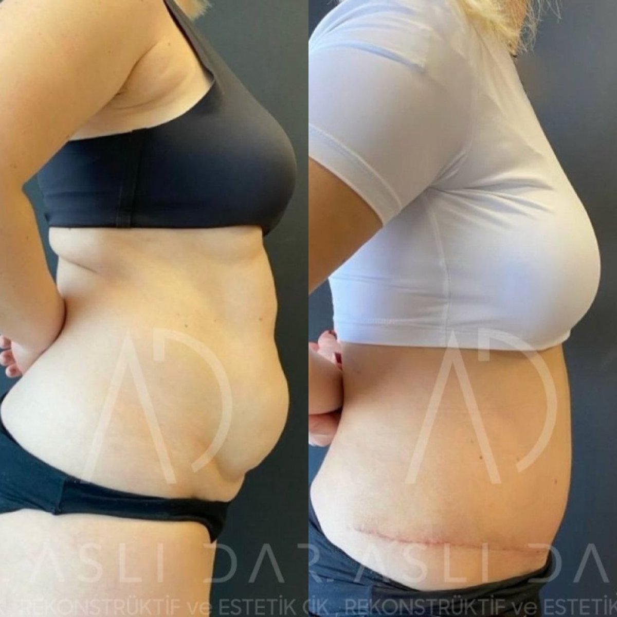 Before and after tummy tuck results at Liv Hospital Ulus, visible abdominal contour improvement