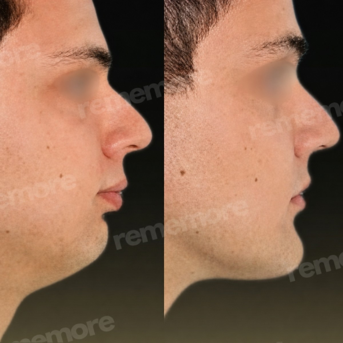 Before and after chin implant results at Memorial Bahçelievler Hospital, improved chin profile