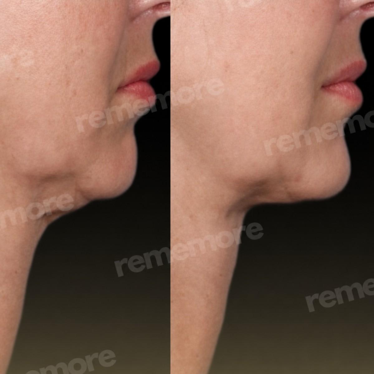 Before and after chin implant results at Memorial Bahçelievler Hospital, improved chin contour