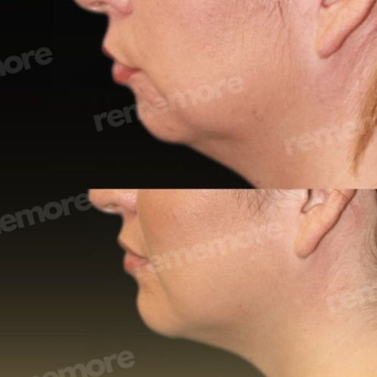 Before and after chin implant results at Memorial Bahçelievler Hospital, improved chin contour