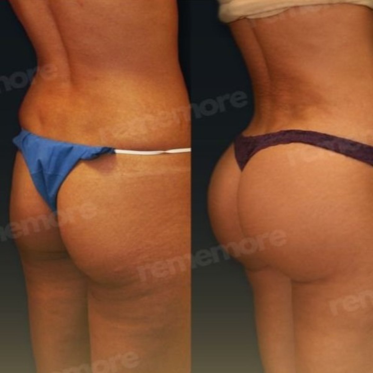 Before and after buttock lift results at Memorial Bahçelievler Hospital, improved contour