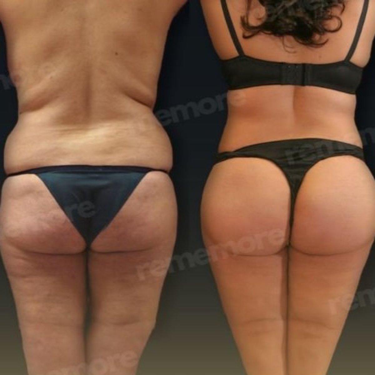 Before and after buttock lift results at Memorial Bahçelievler Hospital, improved contour