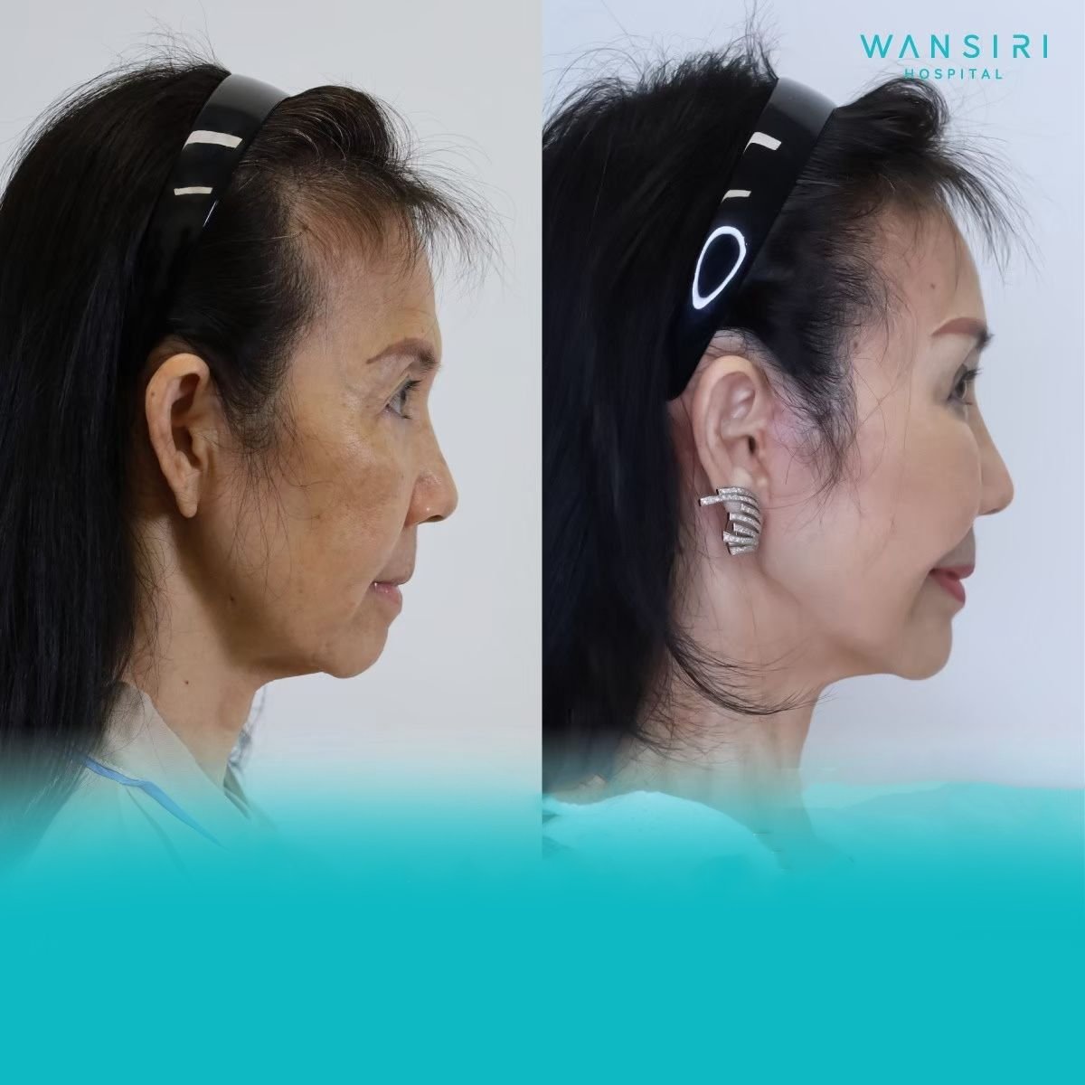 Resultados de blefaroplastia antes y después en Wansiri Hospital, corrección de párpados