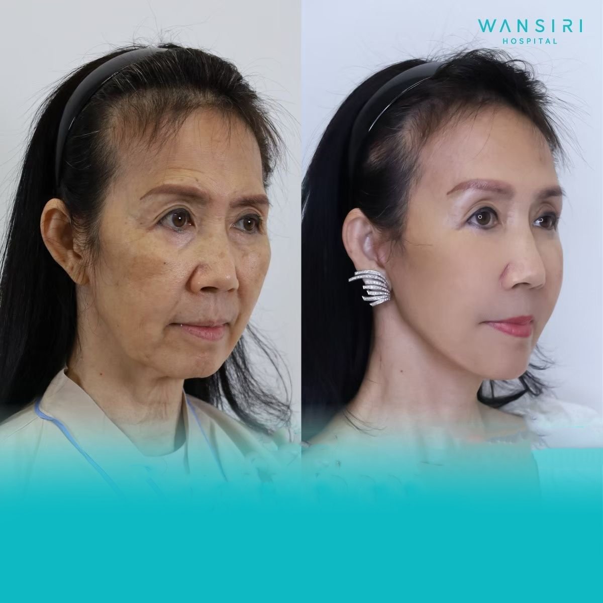 Resultados de blefaroplastia antes y después en Wansiri Hospital, corrección de párpados