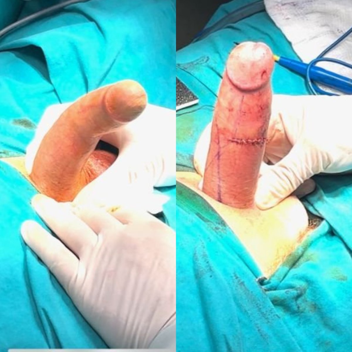 Efekty korekcji skrzywienia prącia w Uroaesthetic – wynik operacji Peyroniego
