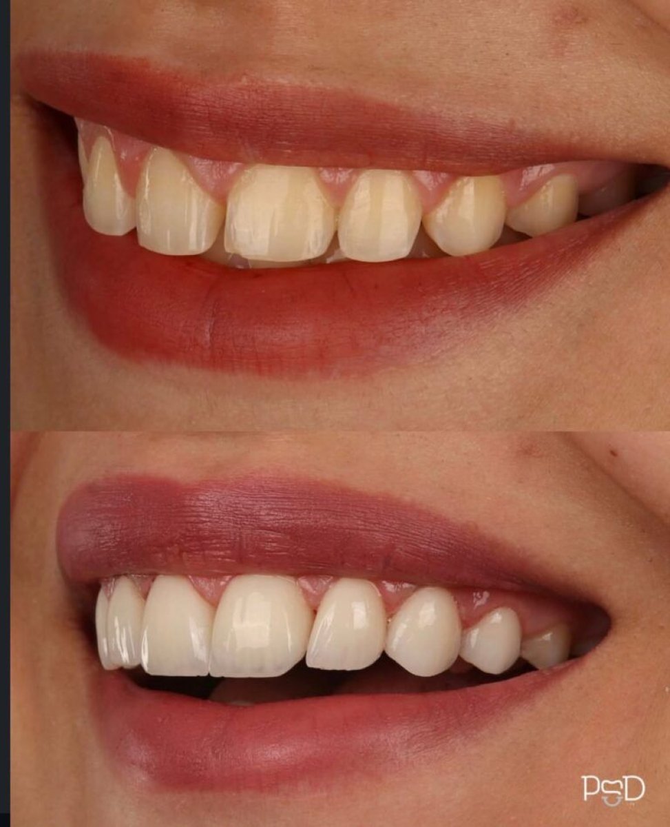 Antes y después de la colocación de coronas dentales en PyraMedicine, mejora estética