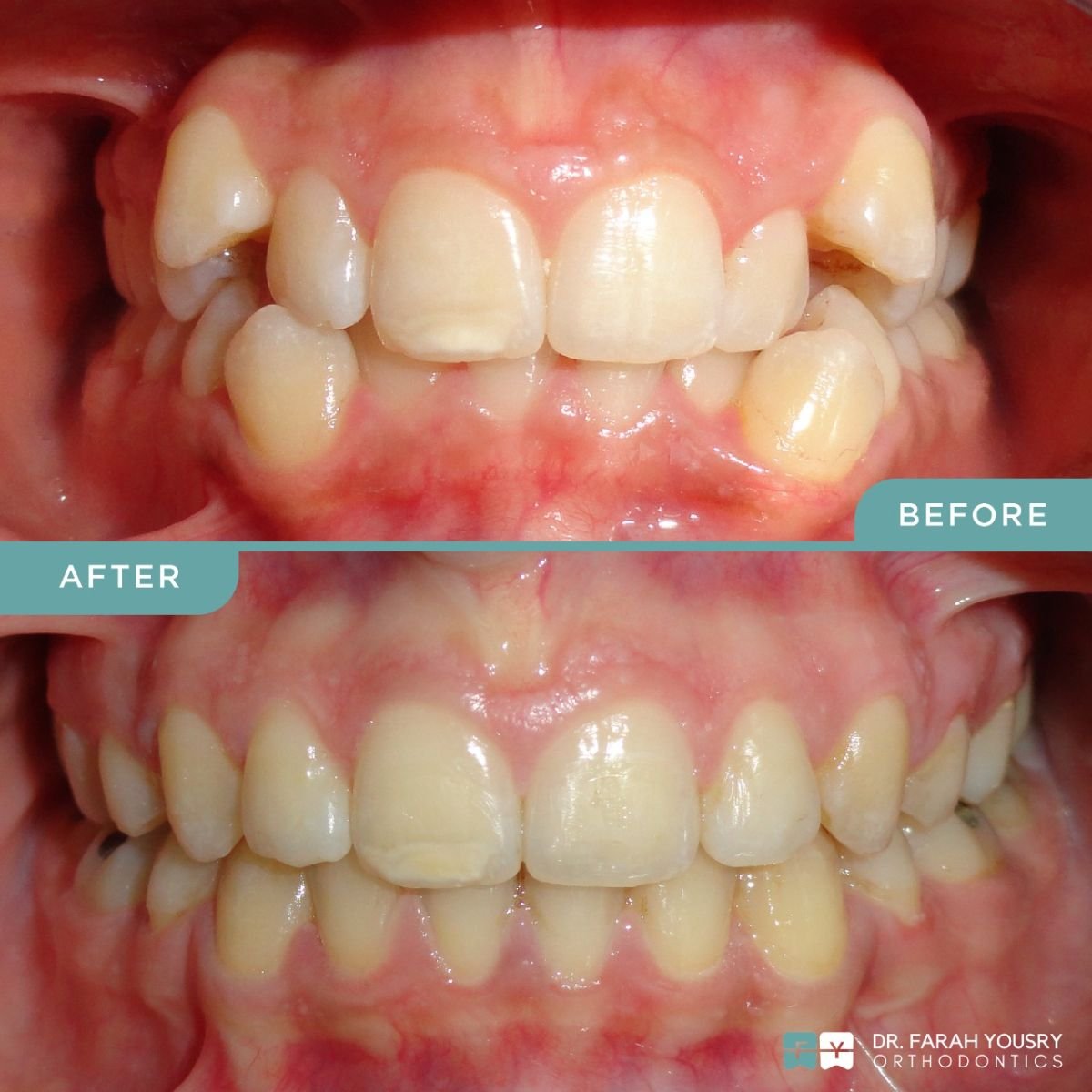 Before and after clear aligners at PyraMedicine – improved teeth alignment result
