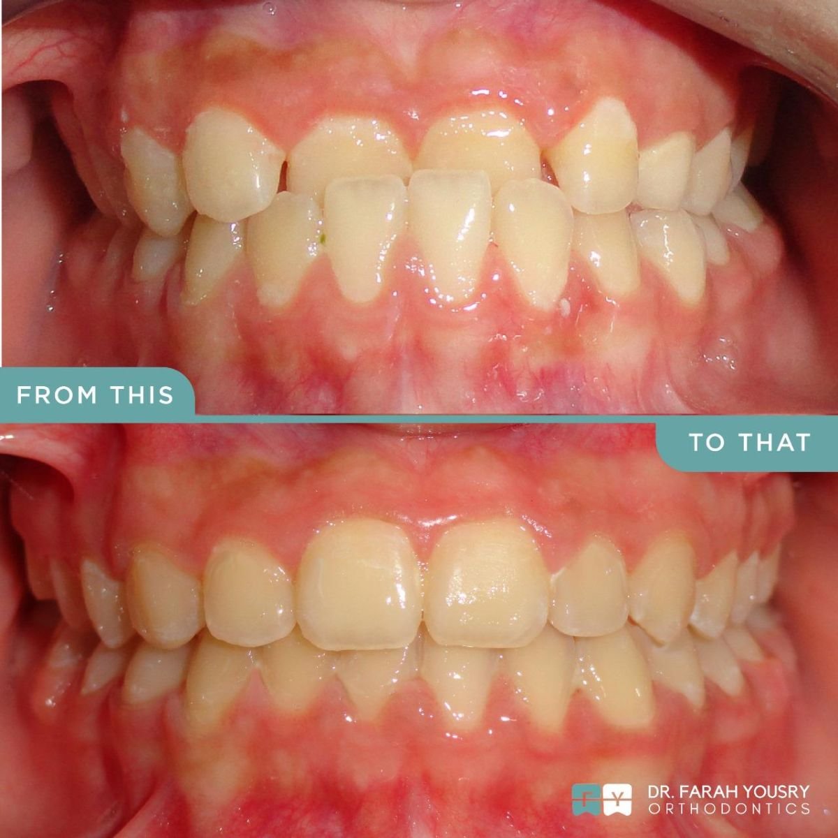 Clear aligners before and after result at PyraMedicine – straighter teeth and improved smile