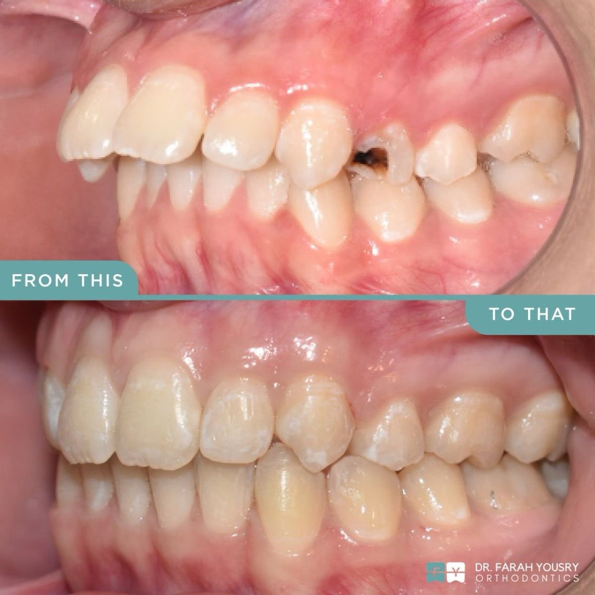 Antes y después de alineadores transparentes en PyraMedicine: mejor alineación dental
