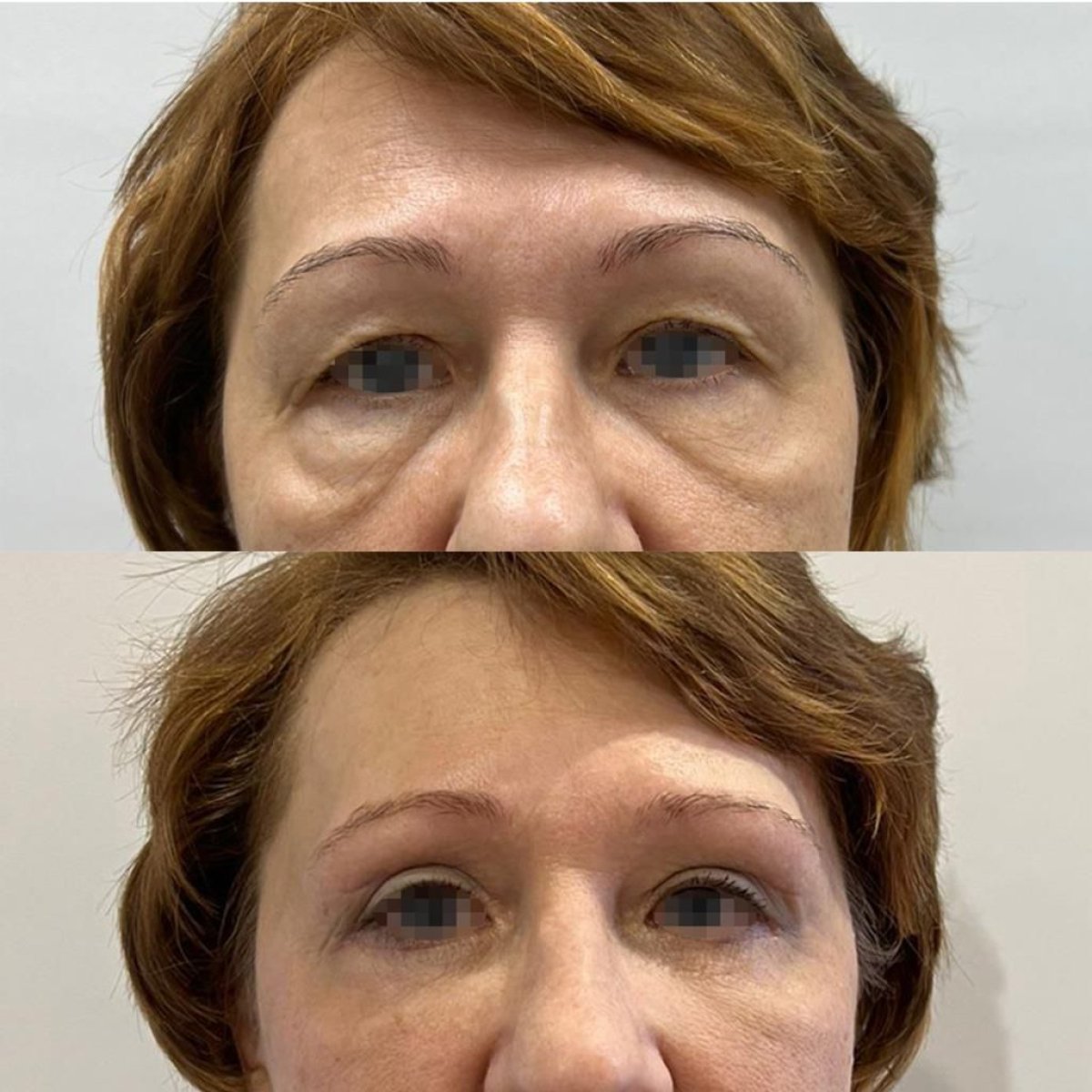 Before and after blepharoplasty results at Altos Clinic – eyelid correction and rejuvenation