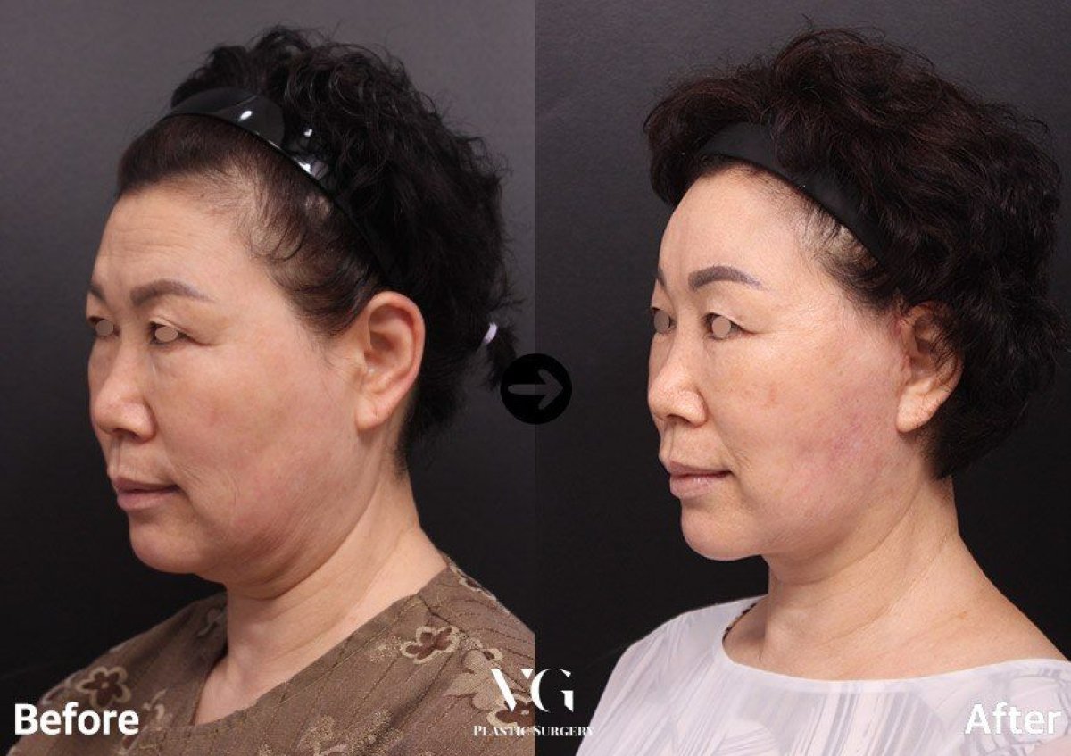 نتائج شد الوجه العميق قبل وبعد في VG Plastic Surgery، تجديد شباب الوجه بوضوح