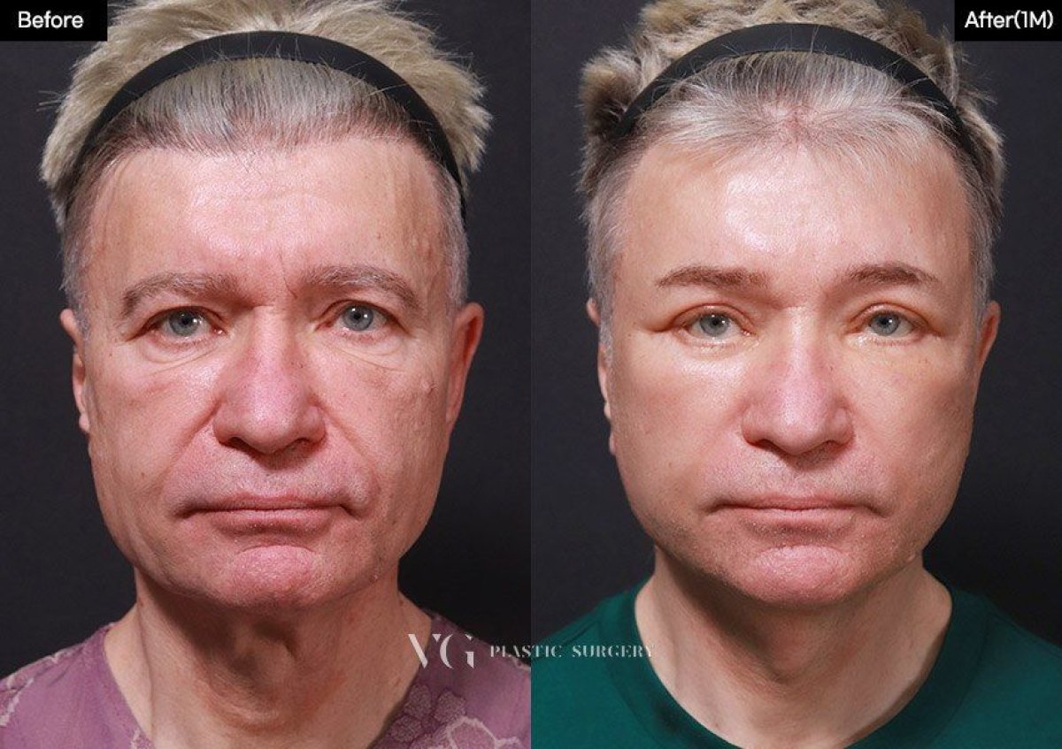 نتائج شد الوجه قبل وبعد في VG Plastic Surgery، تجديد شباب الوجه لمريض ذكر
