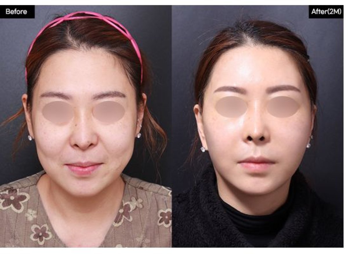 Результаты липофилинга лица до и после в VG Plastic Surgery – улучшенный объем лица