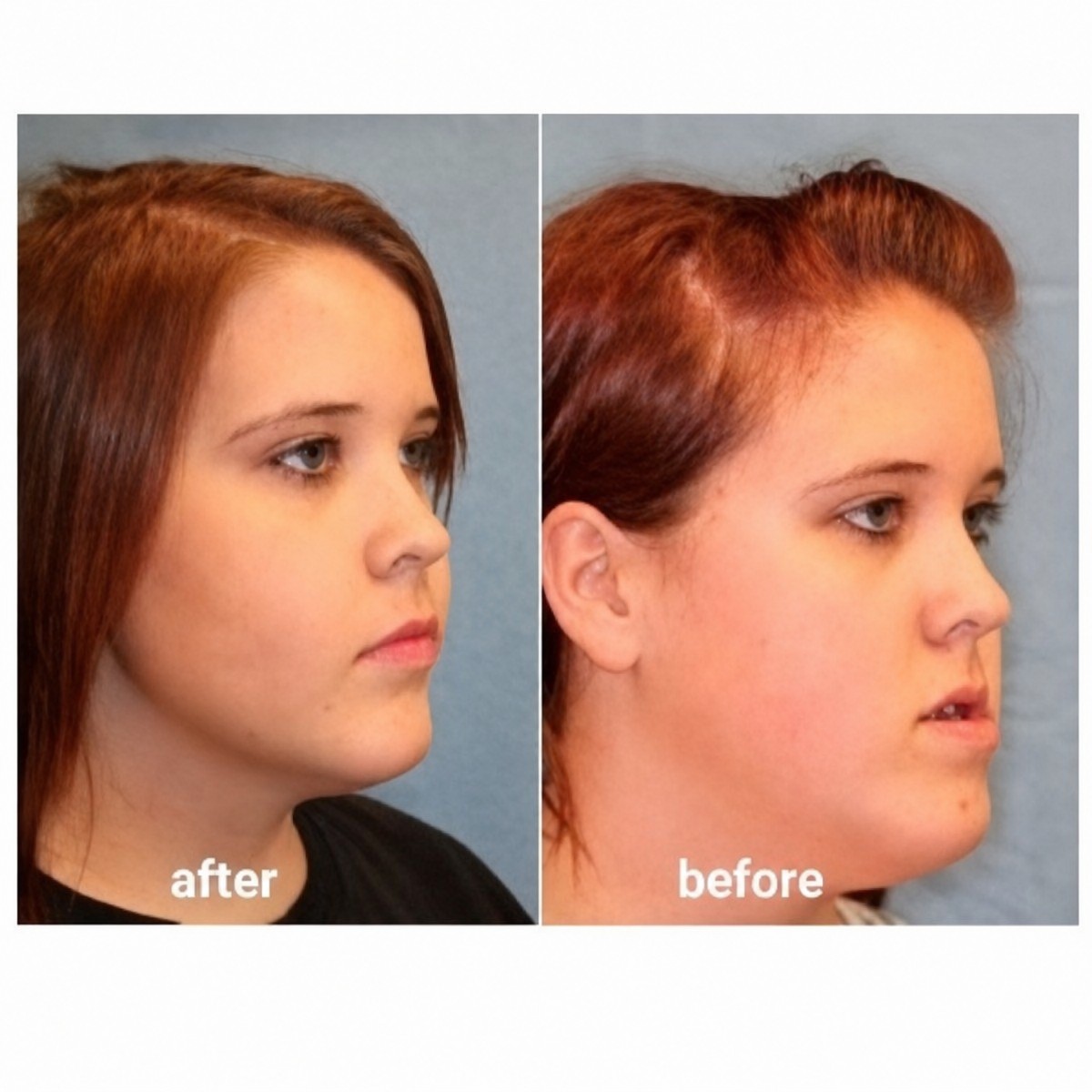 Before and after Vaser liposuction results at ID Clinic Bangkok, improved jawline contour