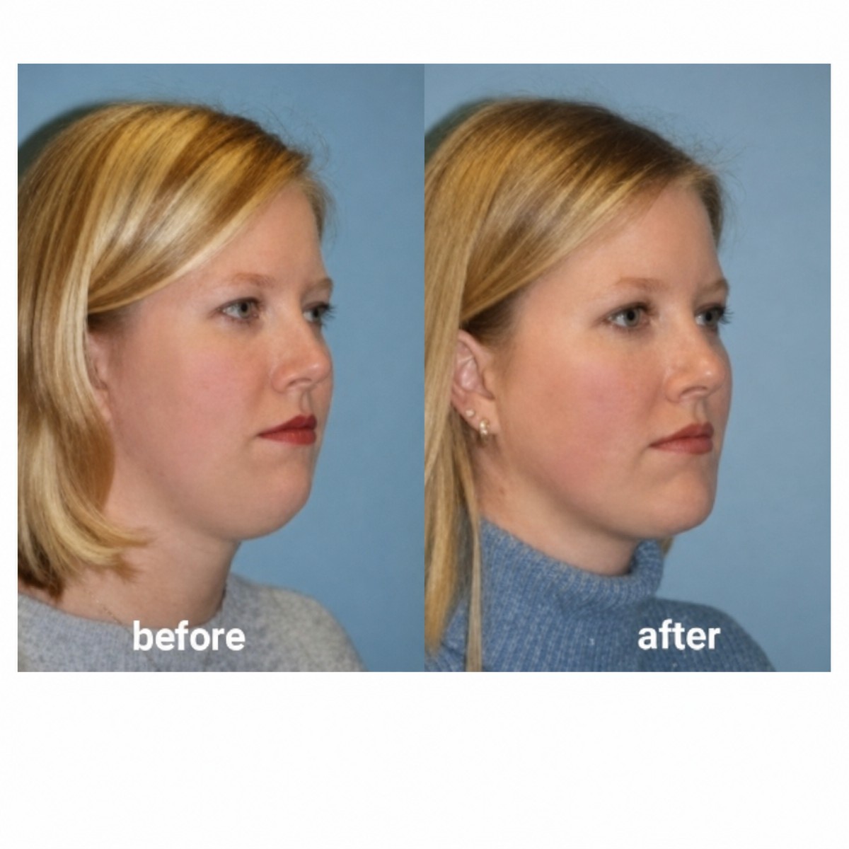 Before and after Vaser liposuction result at ID Clinic Bangkok, improved chin and jawline contour