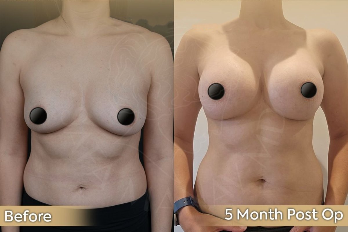 Resultados de aumento de senos antes y después en Dr. Safa Manav Clinic, 5 meses post-op