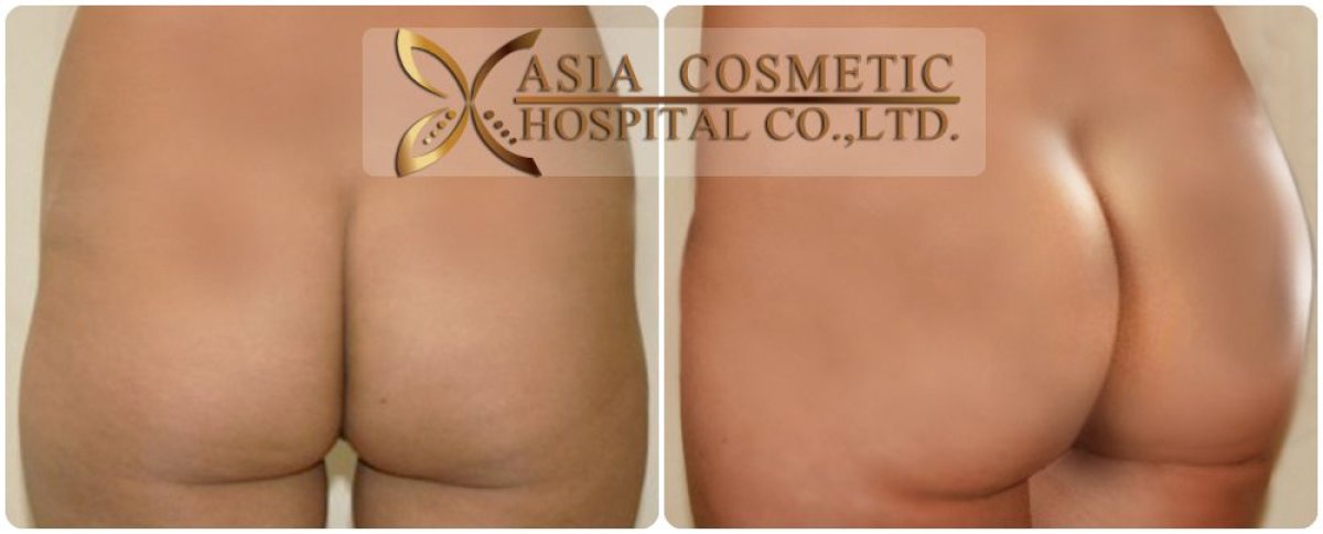 Before and after Brazilian Butt Lift results at Asia Cosmetic Hospital, enhanced buttock contour