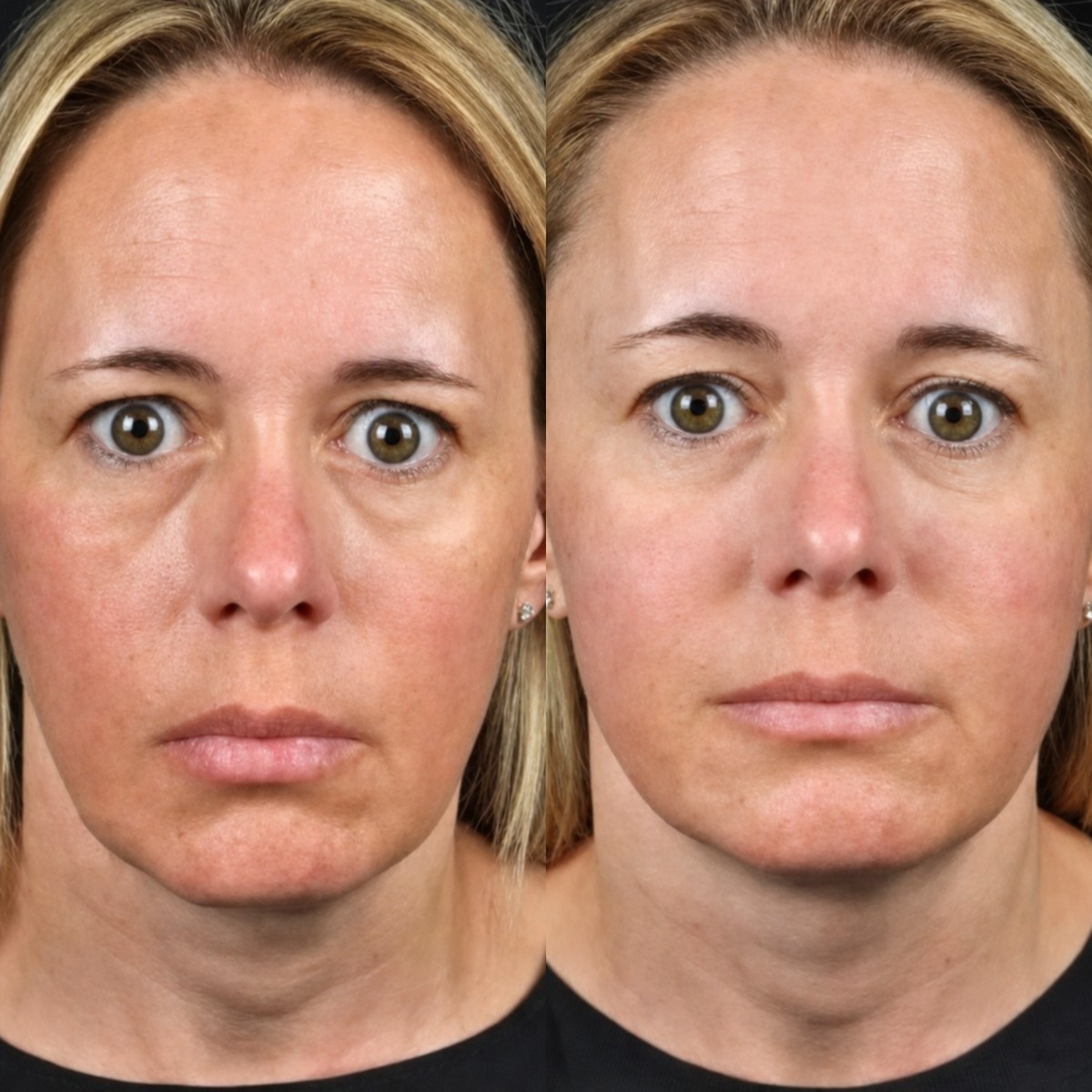 Before and after threads lifting at Plenary Wellness, facial skin tightening visible result