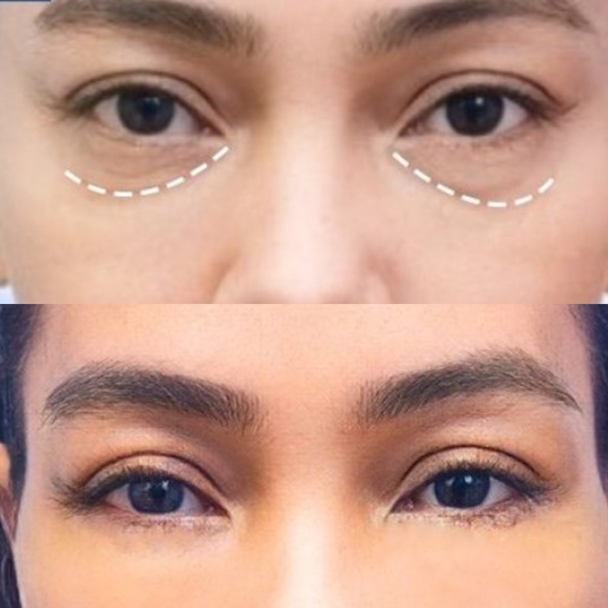 Before and after lower eyelid blepharoplasty results at Asia Cosmetic Hospital, reduced eye bags