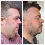 Facelift results by Dr. Im Young Min - Patient’s before and after images Before and after Facelift photos by Dr. Im Young Min