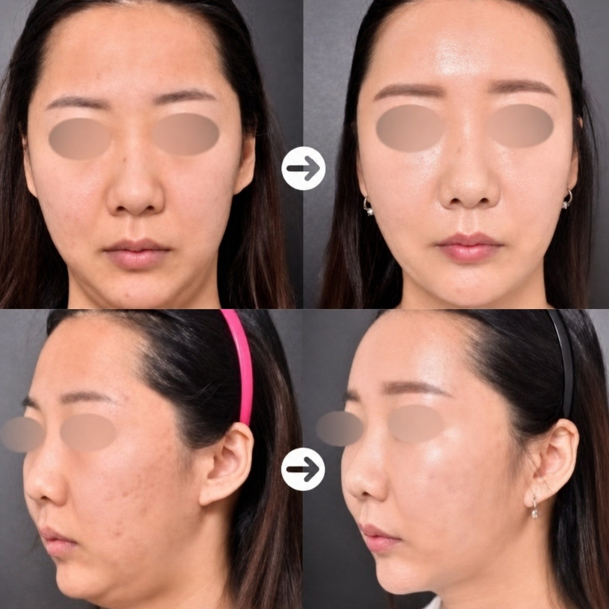 نتائج حقن الدهون في الوجه قبل وبعد في VG Plastic Surgery – زيادة امتلاء الوجه
