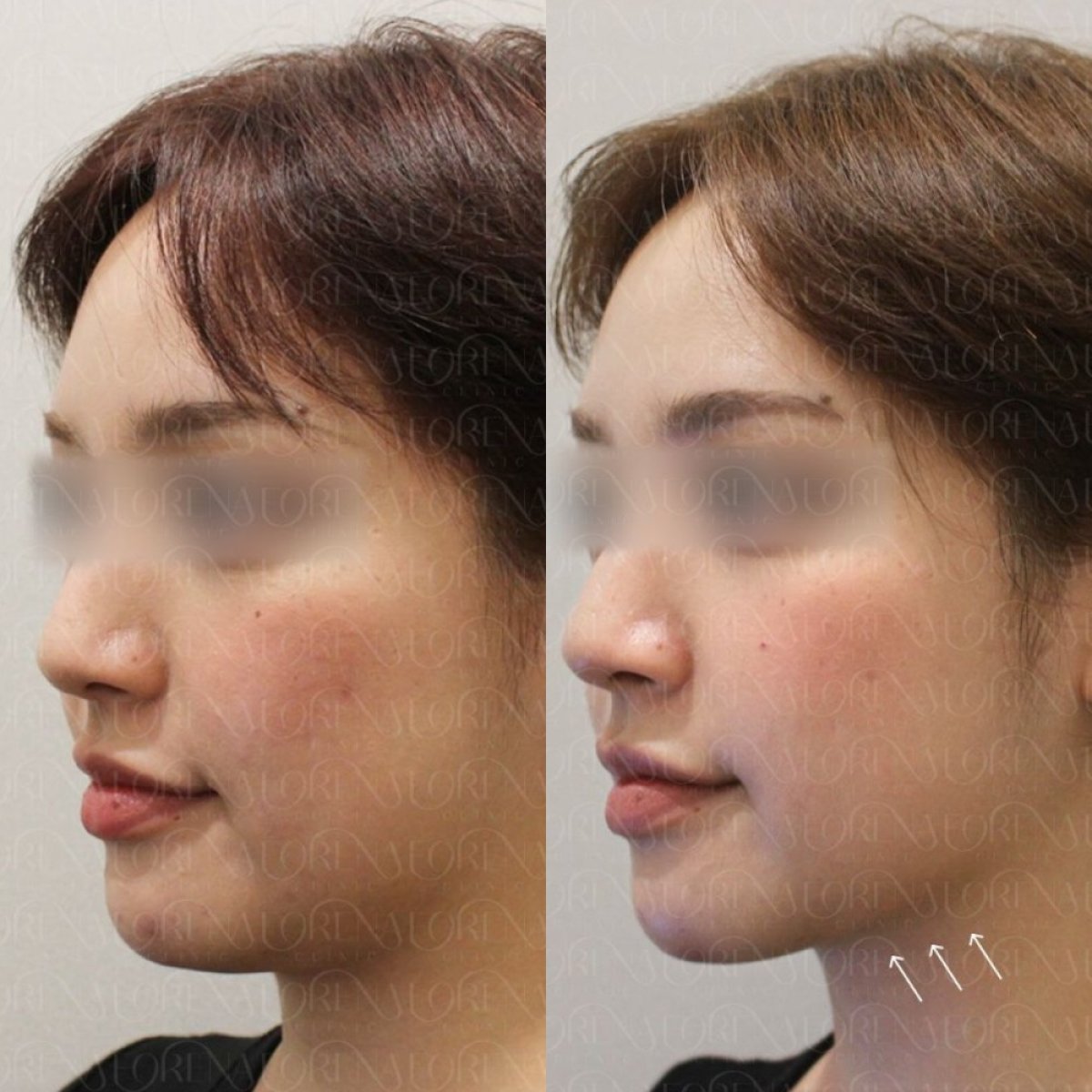 Before and after Ultherapy at Forena Clinic – visible jawline lift and skin tightening result