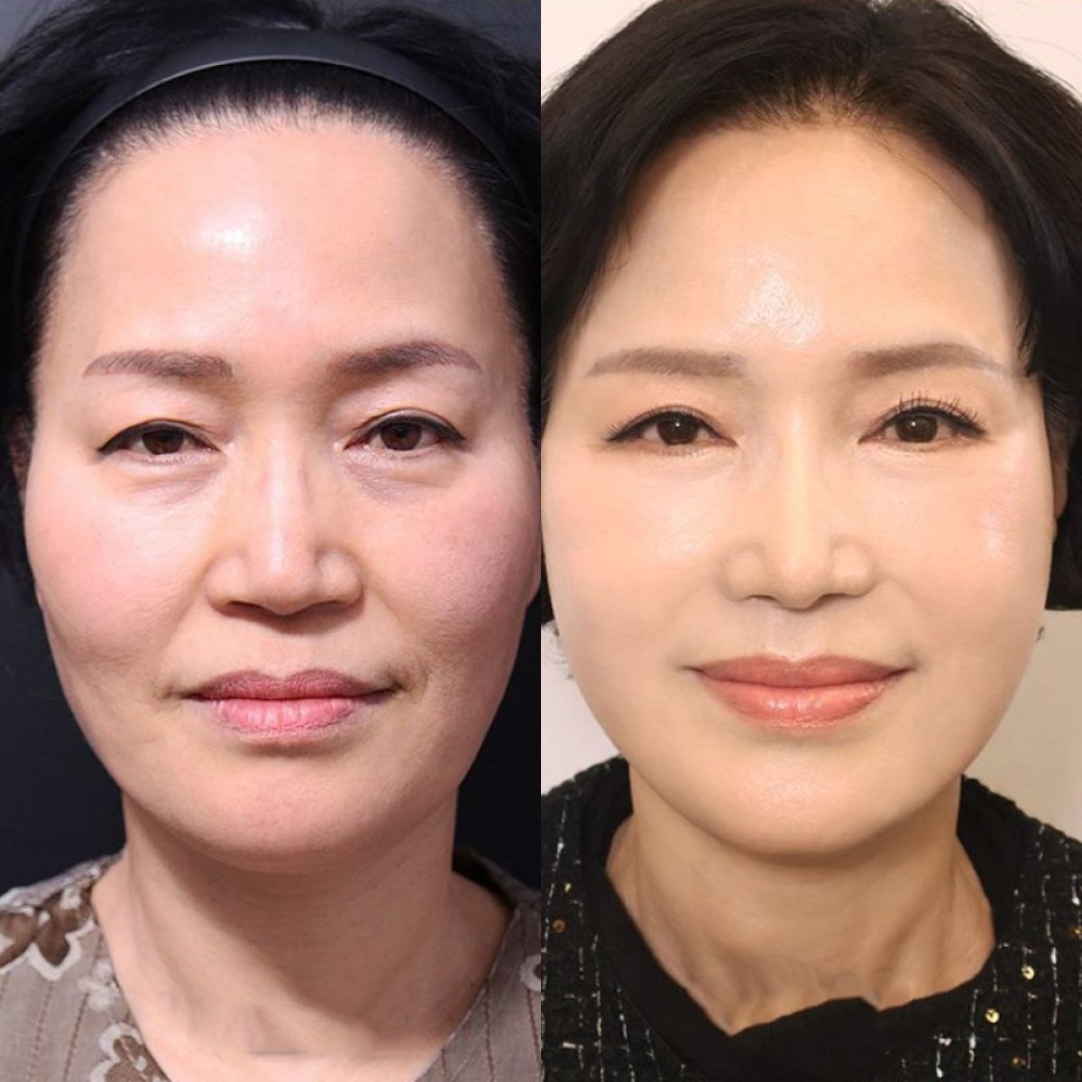 Before and after endoscopic facelift results at Returning Plastic Surgery, facial rejuvenation